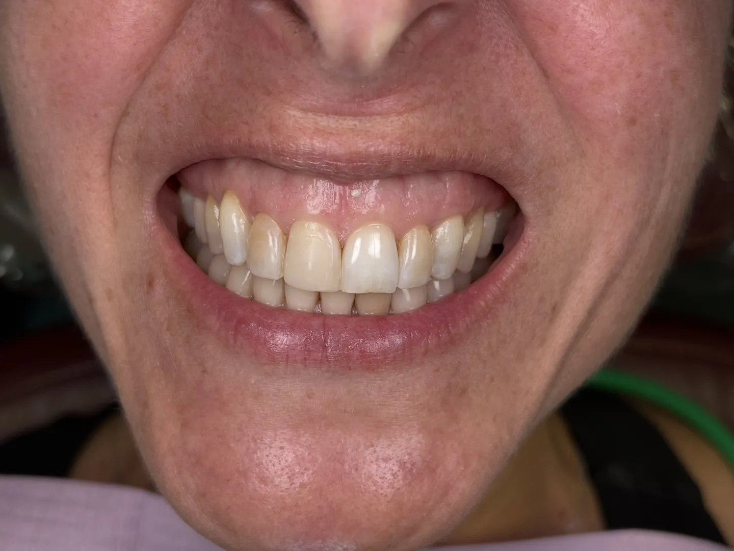 Before: front teeth with a worn edge