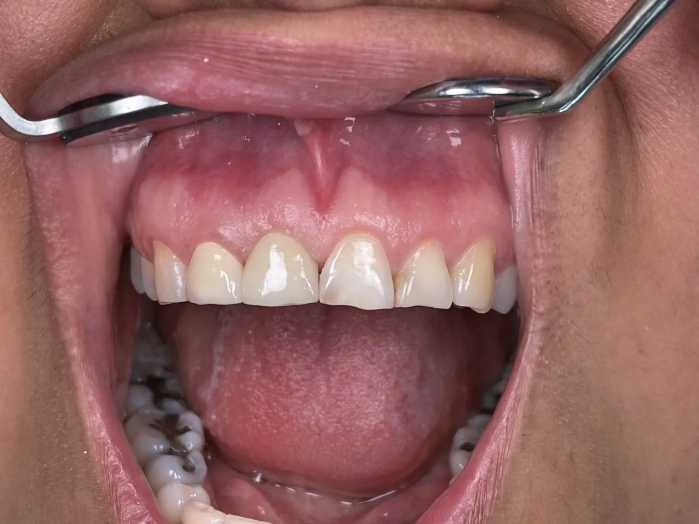 After: the upper front teeth complete