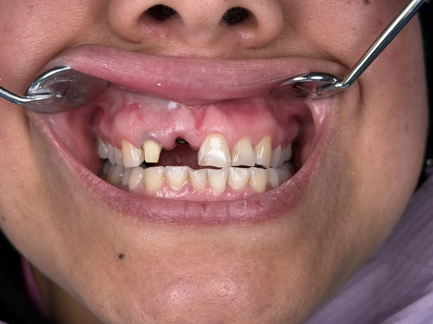 Before: a missing upper front tooth