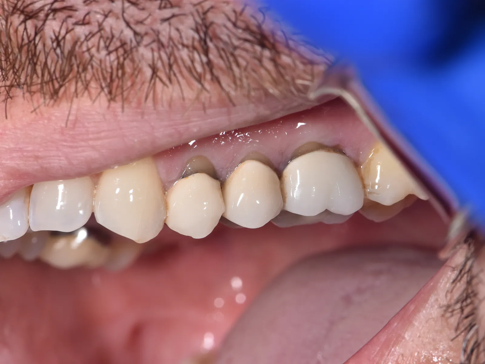 Before: older metal-based crowns with dark lines at the gum