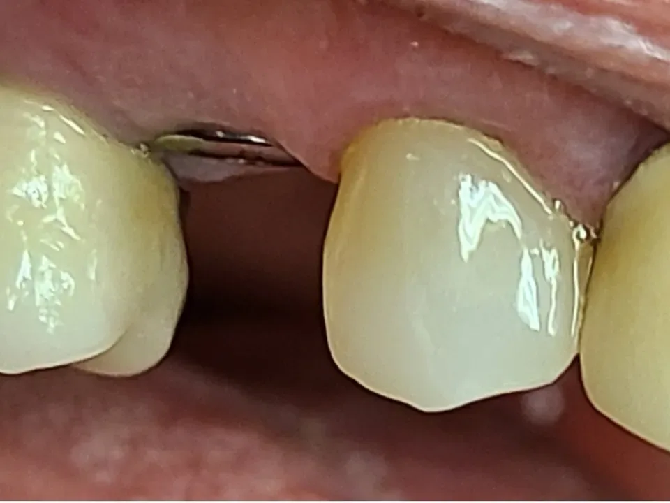 Before: a gap where a tooth was missing