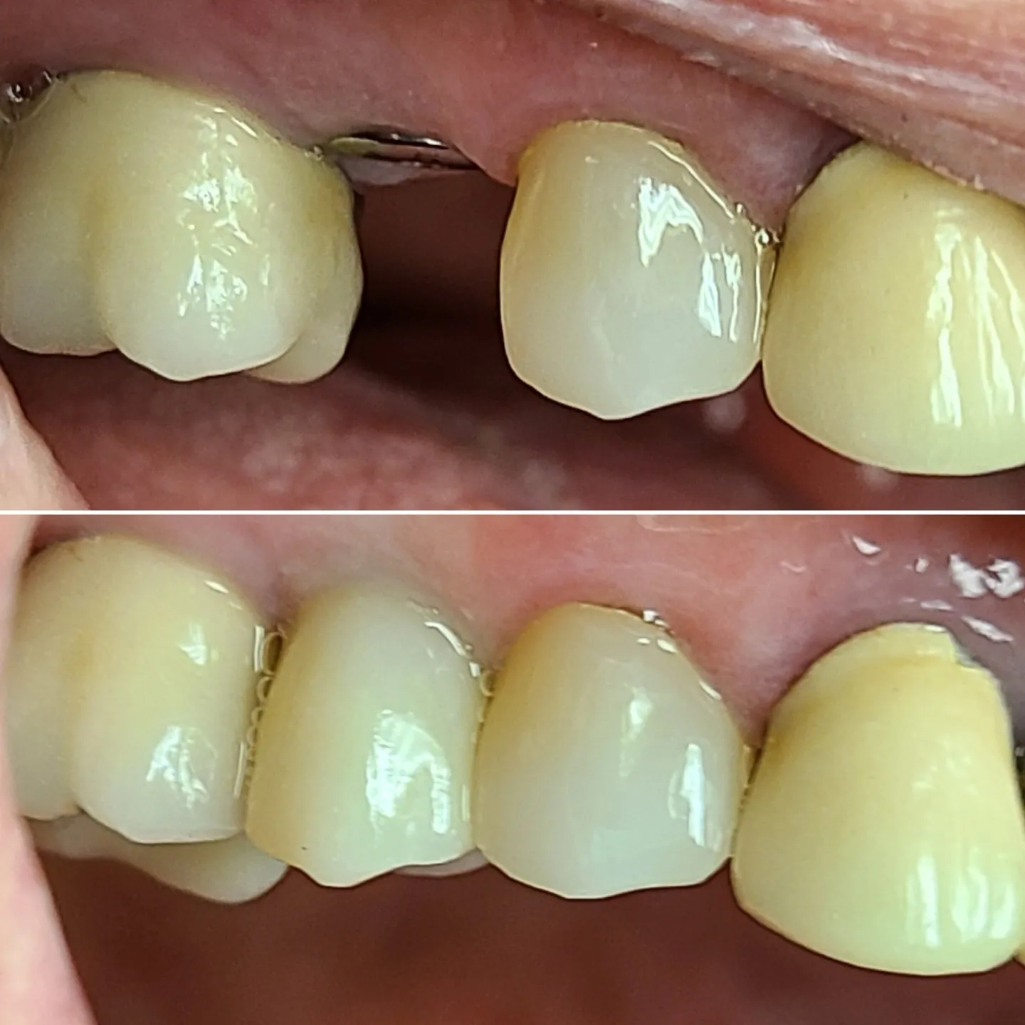 A gap where a tooth was missing, above, and the same area with an implant crown, below