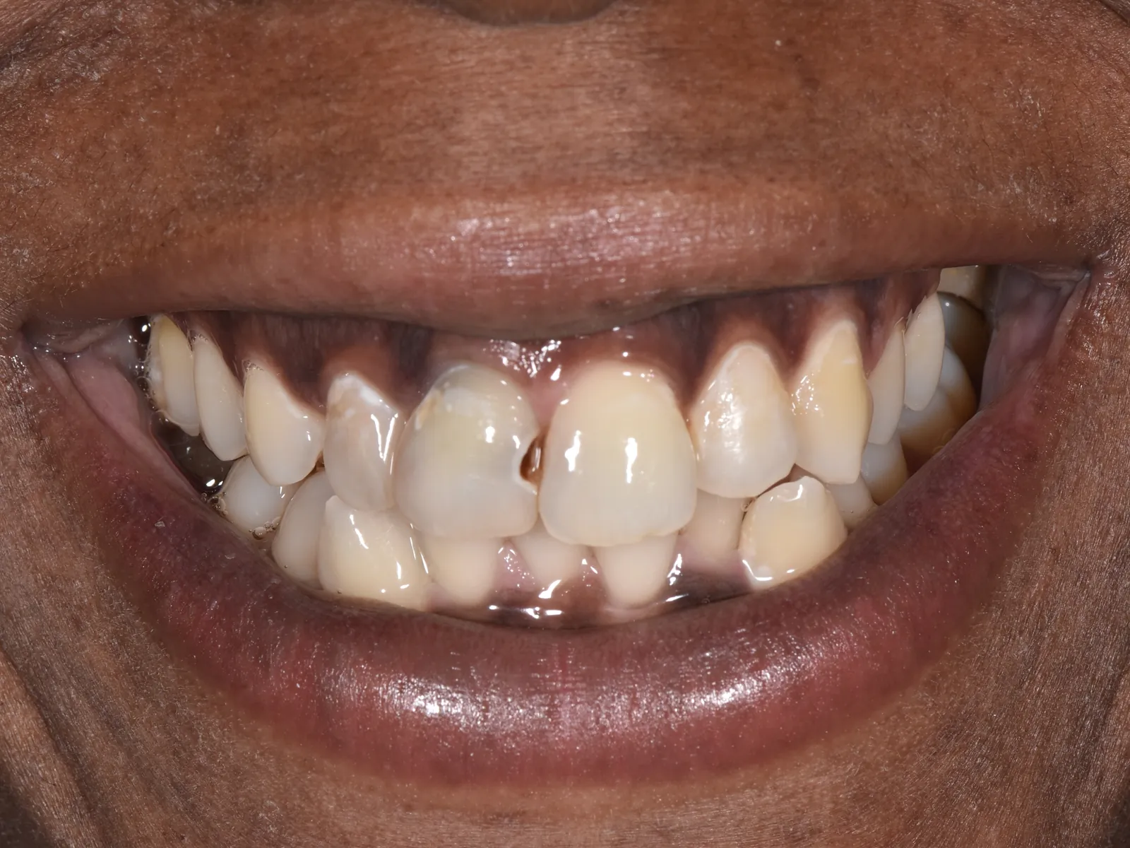 Before: worn and discolored front teeth
