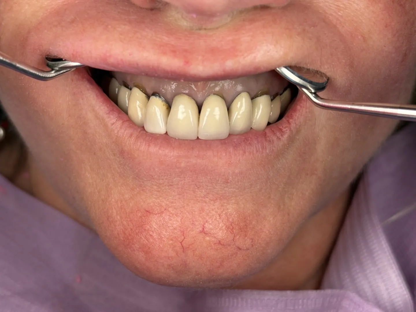Before: worn, yellowed upper teeth