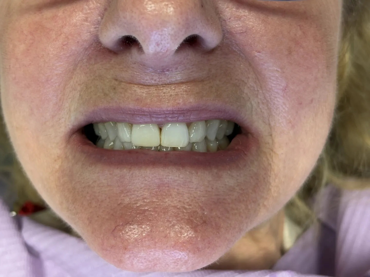 Before: discolored front teeth