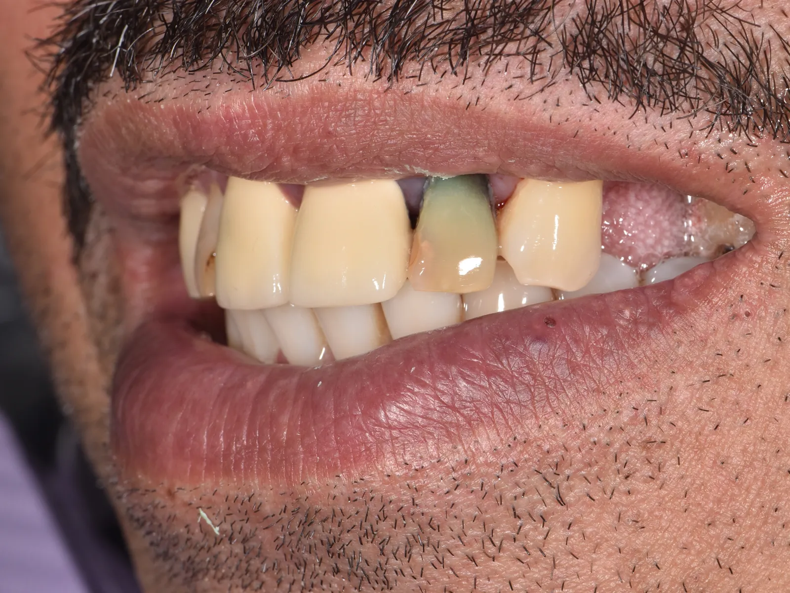 Before: a discolored front tooth and a gap from a missing tooth