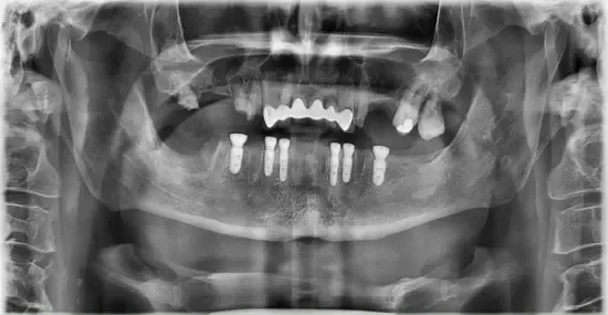 After: X-ray showing a full arch supported by implants