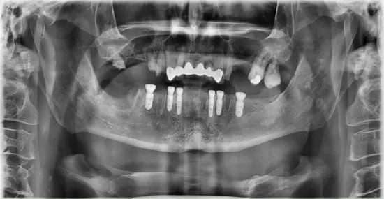 Patient Two after treatment