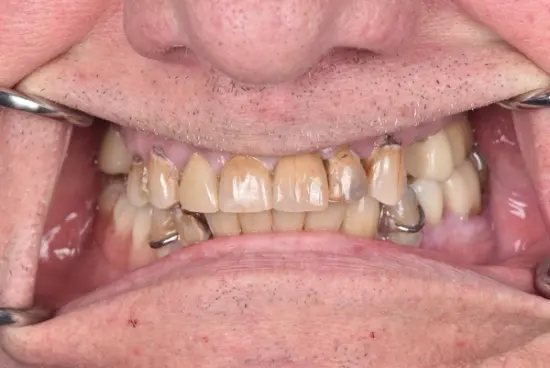 Smile transformation after treatment