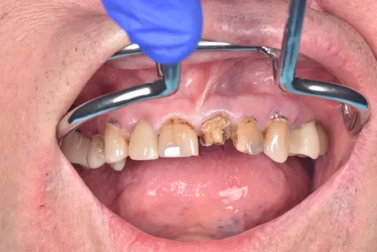 Dental Crowns