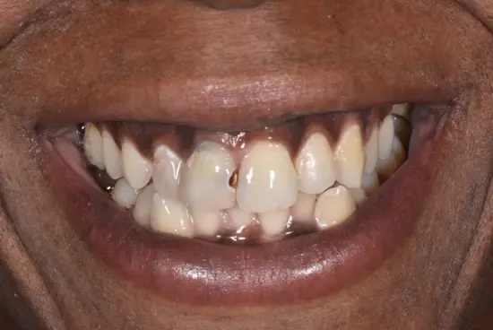 Tooth replacement transformation before treatment