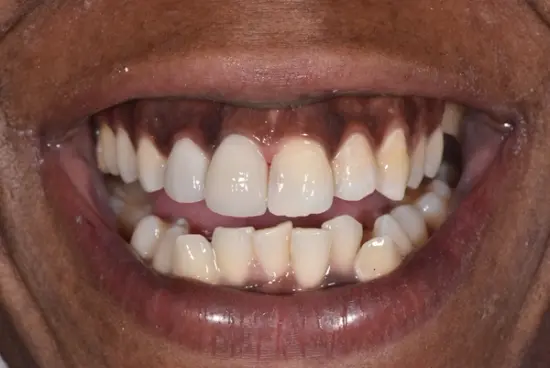 Tooth replacement transformation after treatment
