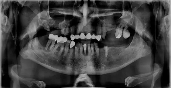 Patient Two before treatment