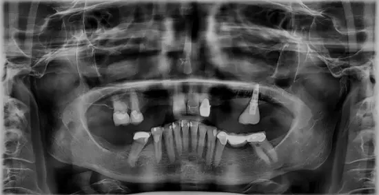 Patient One before treatment