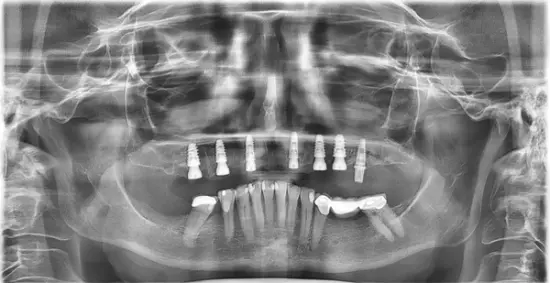Patient One after treatment