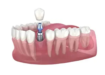 an illustration of a dental implant being placed in a tooth .